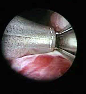 ઝાયડસ હૉસ્પિટલમાં વડોદરા શહેરની પહેલી ‘યુરોલિફ્ટ’ પ્રોસીજર સફળતાપૂર્વક કરવામાં આવી  